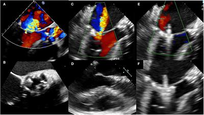 Transcatheter Aortic Valve Replacement and Concomitant Mitral Regurgitation